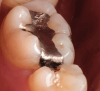 Fotografia nawiązuje do zagrożenia plombami amalgamotowymi (toksyna rtęć) i przedstawia ząb z takim wypełnieniem.